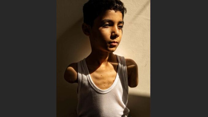 Una imagen sobre las secuelas de la guerra en niños gazatíes gana el World Press Photo