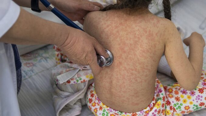 Aumentan a mil 520 los casos de sarampión en México; reportan cuatro muertes