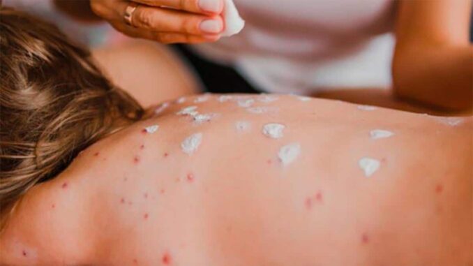 México acumula 12 muertes por sarampión