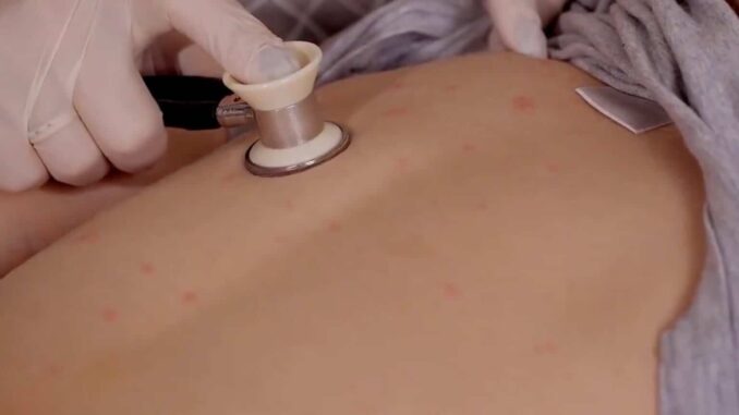 Situación del sarampión en México no está controlada, casos siguen en aumento: diputado Éctor Jaime Ramírez