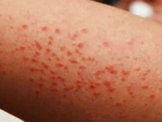 Brote de sarampión: Ssa reporta 23 muertes