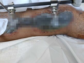 Paciente del IMSS Morelos denuncia que perderá una pierna por negligencia médica