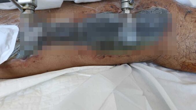 Paciente del IMSS Morelos denuncia que perderá una pierna por negligencia médica