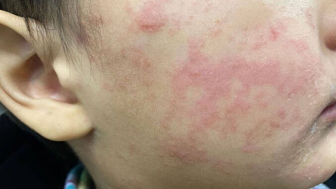 Sarampión supera los 2 mil casos en lo que va de 2026