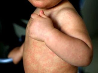 México rebasa los 10 mil casos de sarampión